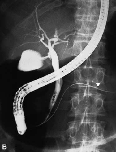 Double Guidewire Technique For Difficult Bile Duct Cannulation A Multicenter Randomized