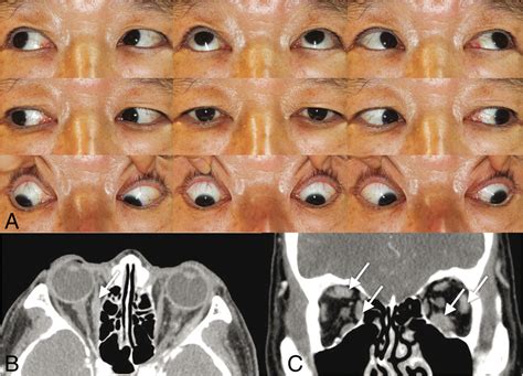 Igg4 Related Ophthalmic Disease Involving Extraocular Muscles Case