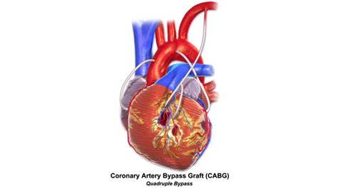 Coronary Artery Bypass Graft Cabg