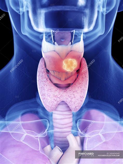Illustration Of Larynx Cancer In Human Body Silhouette — Tumor Tumour