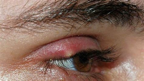 Facial Swelling Causes Symptoms Treatments And More Eye Stye