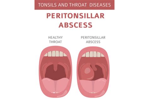 Tonsil Peritonsillar Abscess