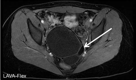 Ovarian Dermoid Cyst Mri Radiologypicscom