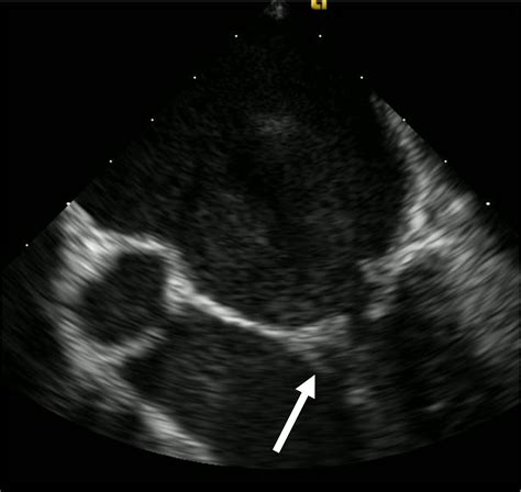 Cureus Native Mitral Valve Infective Endocarditis From Flossing A