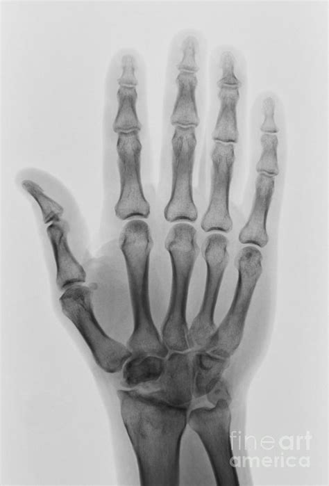 Healthy Hand X Ray Photograph By Scott Camazine Pixels
