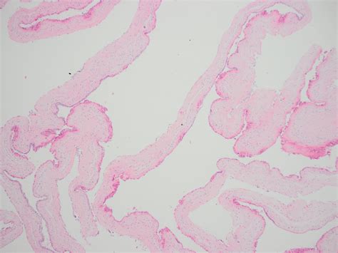 Amnion Nodosum Placenta Image