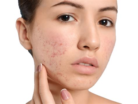 Does Your Skin Look Like This Beat Acne Scarring For Good And Regain