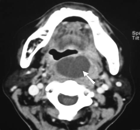 Ct Scan Of The Neck Contrasted Showing Large Lobulated Mass With
