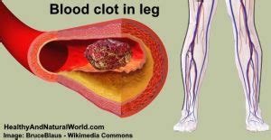 Blood Clot In Leg Signs Of A Blood Clot In The Leg My Xxx Hot Girl