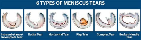 Meniscus Tear Knee Symptoms Signs Diagnosis Treatment And Recovery