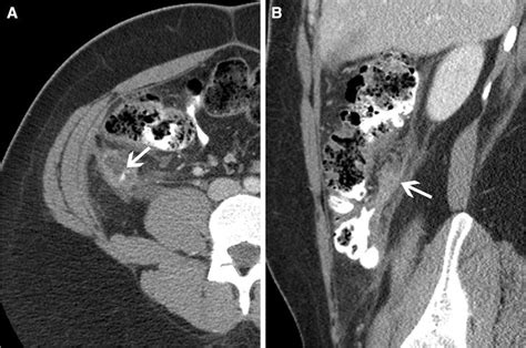 Stump Appendicitis In A 24 Year Old Post Appendectomy Man A Axial Ct