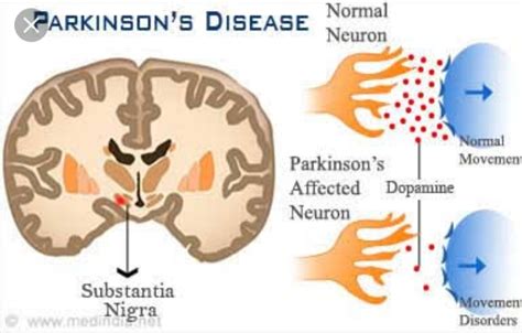 Parkinsons Disease Symptoms Causes Stages And Treatment Santripty