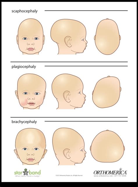 Flat Head Syndrome Adults