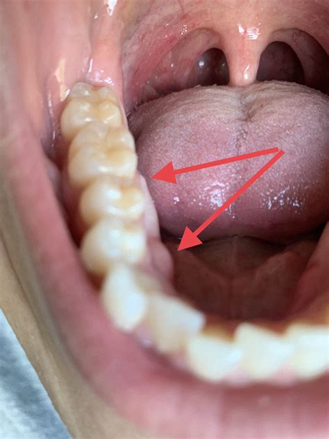 What Are These Hard Bumps On Bottom Inside Gum Dentistry