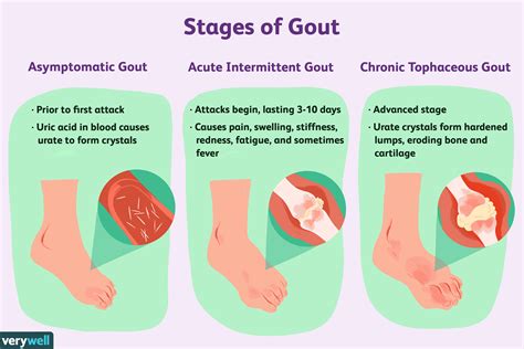 Gout Symptoms Pictures Treatment And More