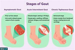 Gout: Symptoms, Pictures, Treatment, and More Gout  