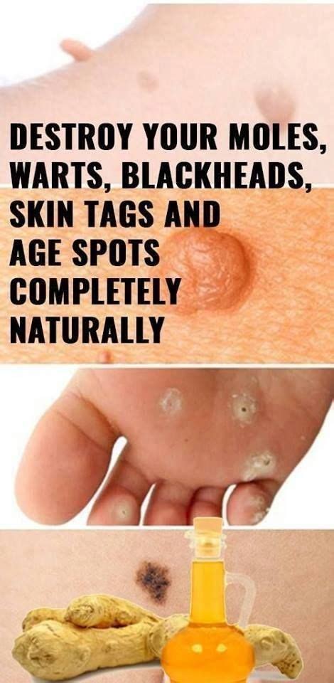 Natural Ways To Remove Moles Warts Blackheads Skin Tags And Dark