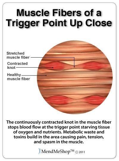 Muscle Fibers Of Trigger Points Up Close Massage Therapy Trigger
