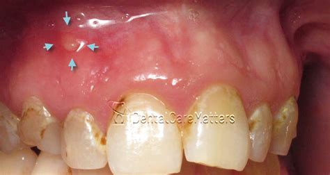 Small Blisters On Gums Around Teeth Teethwalls