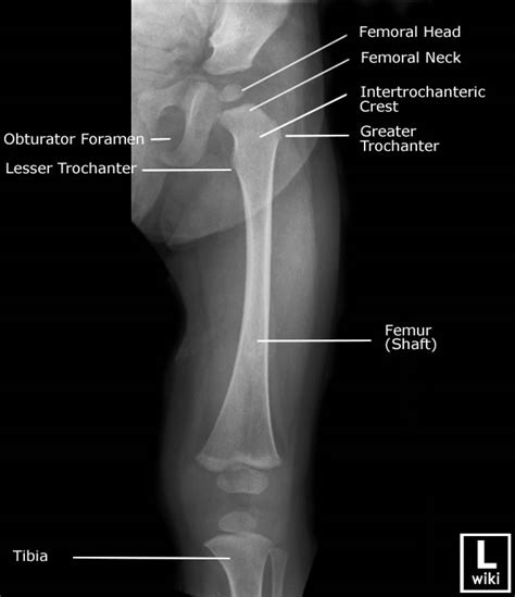 Paediatric Femur Wikiradiography