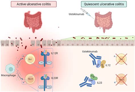 Targeting Il In Ulcerative Colitis Update On The Role Of