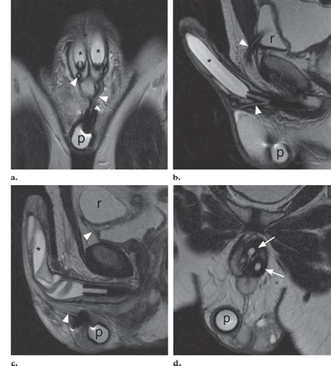 Figure 16 From Mr Imaging Of Nonmalignant Penile Lesions Semantic