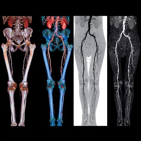 6.13 ct angiography of the right upper limb: Vascular Imaging - Run-off CT Angiography - Siemens ...