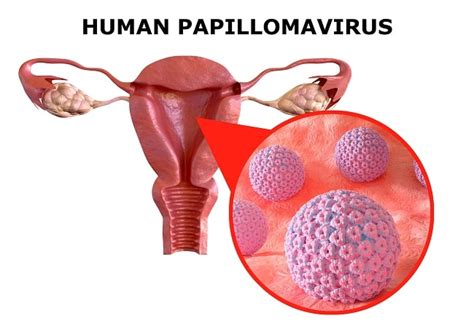 Diagnosis Human Papillomavirus HPV Alomedika