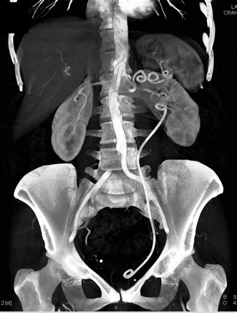 Left Ureteral Stent Within Distal Ureter And Not In Bladder Kidney