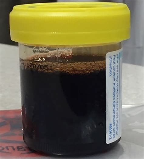 Bounce Back With Black Urine A Case Report The American Journal Of