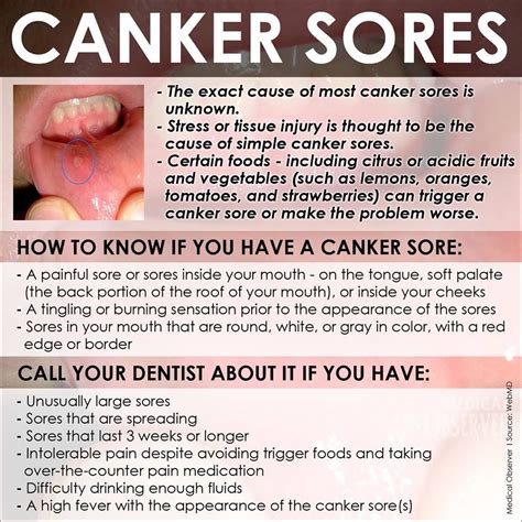 Canker Sores Canker Sore Cankers Remedies