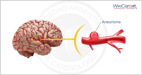 Aneurisma Cerebral Wikicardio