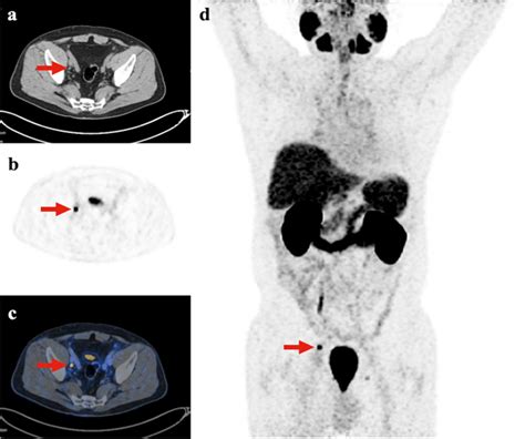 Lymph Node Involvement Detected On ⁶⁸ga Psma 11 Petct In A Patient