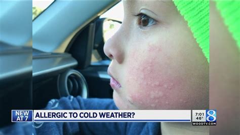 Doctor Explains Allergy To Cold Weather Youtube