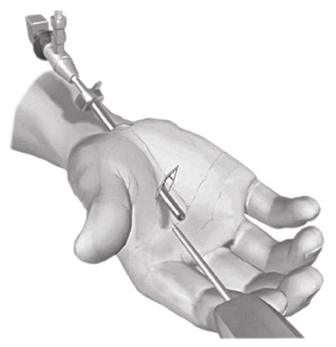 Endoscopically Assisted Carpal Tunnel Release Ectr Download