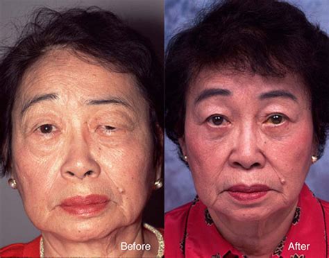 Many fellow sufferers of bell's palsy wrote in to share their stories. Bell's Palsy Beverly Hills | Facial Paralysis Treatment ...