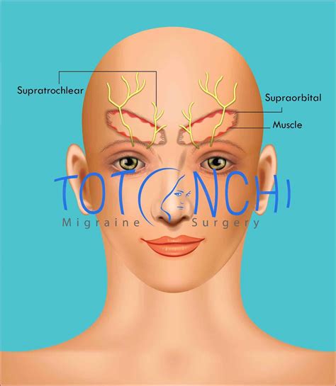 Frontal Trigger Point Migraine Surgery Cleveland