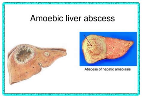 Liver Abscess Histology