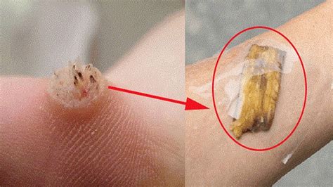 How To Get Rid Of Warts Fast Naturally Youtube