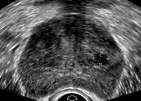 Transverse Transrectal Ultrasound Image Of The Mid Prostate There Is A