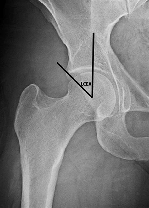 Anteroposterior Radiograph Demonstrating The Lateral Center Edge Angle