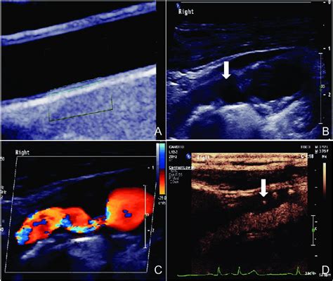 Ultrasonography Exam For The Carotid Artery A Intima Media Thickness