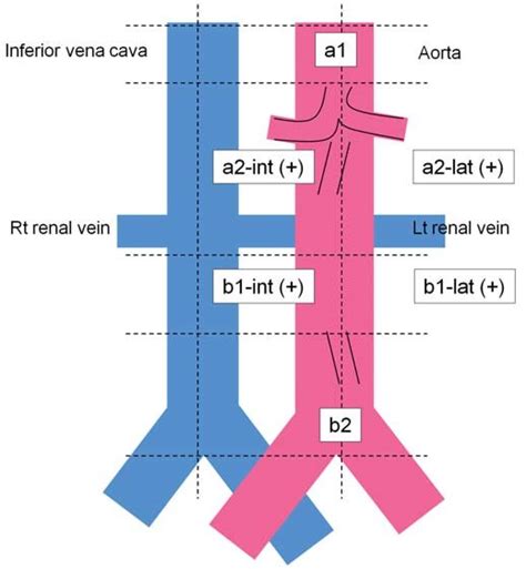 Subgroup Of The Para Aortic Lymph Nodes The A1 Lymph Node Is Defined