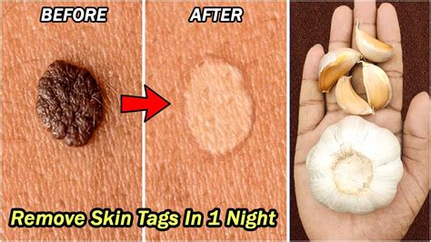 how to remove skin tags in 1 night natural skin tags removal remove skin tags with garlic
