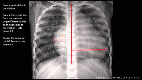 On qtag.com we provide two measurements for chest width for all our t shirts; How to measure Cardiomegaly in CXR - YouTube
