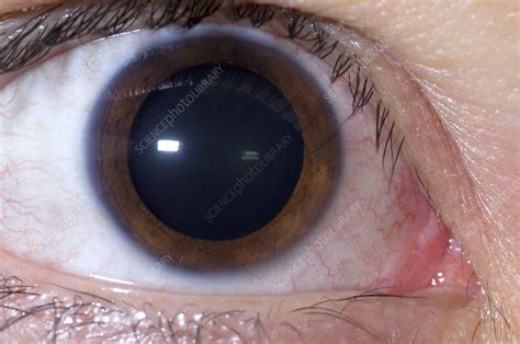 Dilated Pupil Stock Image M1550539 Science Photo Library