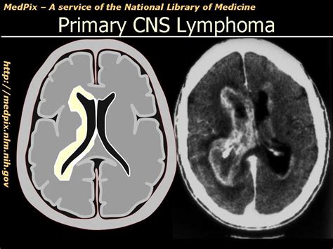 Primary Cns Brain Lymphoma Youtube