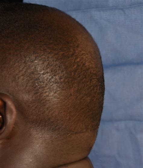 Occipital Skull Reduction With Scalp Tuck Left Side After Dr Barry