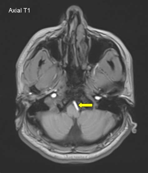 Mricases Isolated Hypoglossal Nerve Palsy Due To A Tortuous Vertebral
