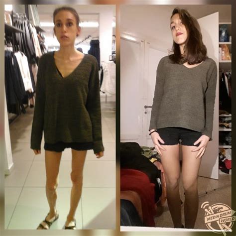 After Surviving On 200 Calories A Day How This Students Anorexia Saw